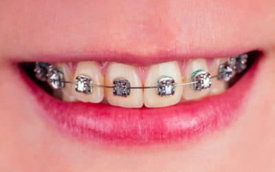 Zahnspangen Verfärbung: Ursachen und Maßnahmen