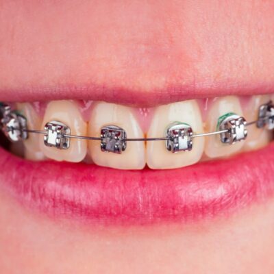 Verfärbungen der Brackets und der Bänder