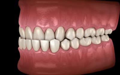 Unterbiss: Ursachen, Folgen und Behandlung der Zahn- und Kieferfehlstellung